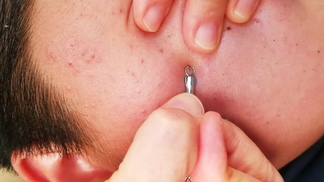 Torture and pain suffer from squeezing pimple blackheads from the face of a teenager with a blackhead popper

