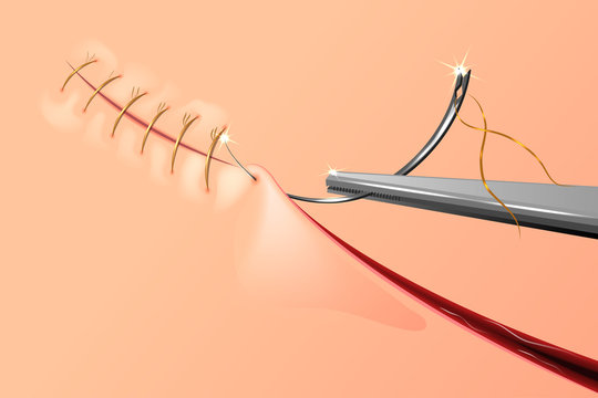 Как самому снять швы собаке Suture Needle Зображення - огляд 34,712 Стокові фото, векторні зображення й віде