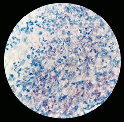 Smear of Acid-Fast bacilli (AFB) stained from human body fluid specimen with positive Mycobacterium...