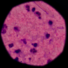 White blood cells with Uric acid crystal needle shape..