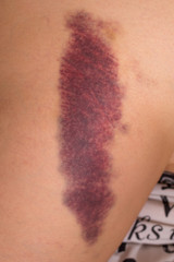 Fototapeta premium Hematoma on the thigh. Bumpy leg.