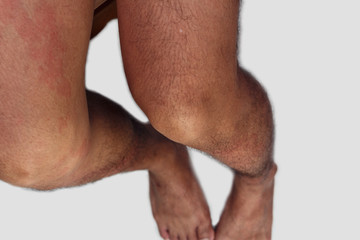 Fototapeta na wymiar Leg area of man with dermatitis problem of rash ,allergy rash and Health problem