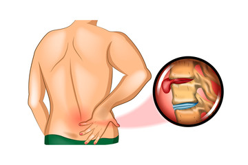 back pain. damage to the spine