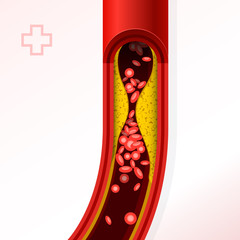 Artery section with cholesterol buildup - cholesterol and thrombosis