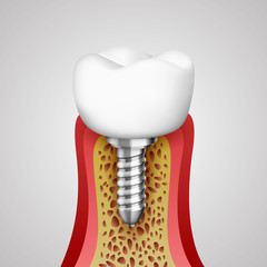 3d teeth in a cut with nerve endings and with an implant. Vector illustration