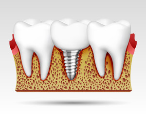 3d teeth in a cut with nerve endings and with an implant. Vector illustration