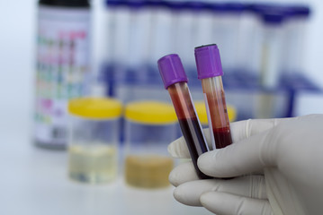 blood test with urine sample test,Doctor holding a container in hand, isolated on white background, Urine sample test.