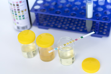Reagent Strip for Urinalysis, Routine Urinalysis, urine test analysis in laboratory. Urine sample test.