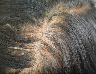 thin hair in women