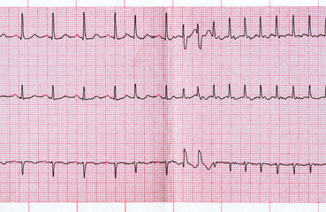 ECG with supraventricular extrasystole and short paroxysm of atrial fibrillation