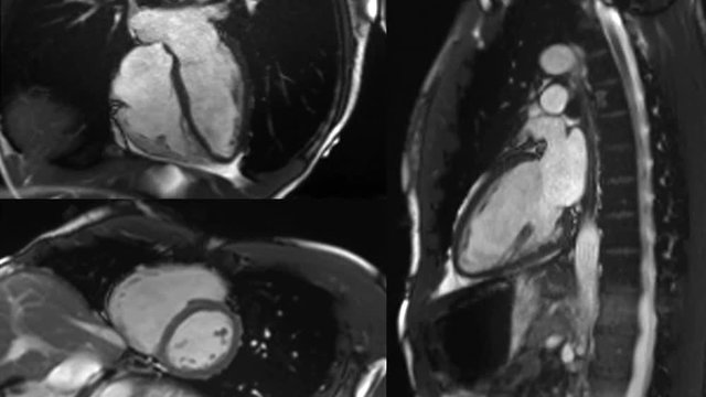 
00:01 | 00:08
1×

heart beating - Cardiac MRI with contrast, 3 angles