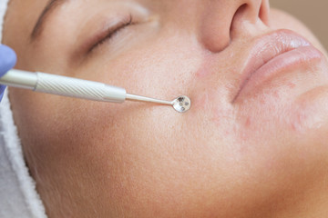 Obraz premium Procedure for cleaning the skin of the face with a steel appliance with a spoon from blackheads and acne.