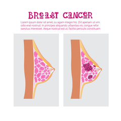 Breast Cancer Awareness Month Pink Ribbon Symbol Flat Vector Illustration