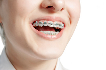 Beautiful young woman with teeth braces