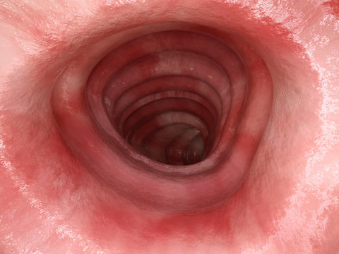Colitis ulcerosa - Stage 1 - 3D rendering