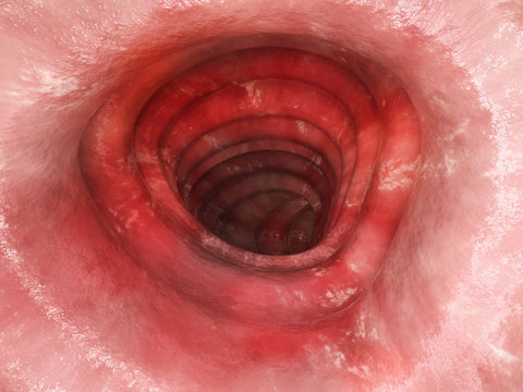 Colitis ulcerosa - Stage 2 - 3D rendering