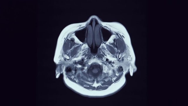 MRI brain scan on black background
