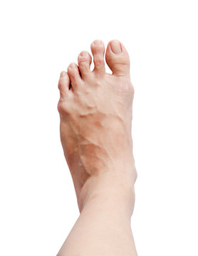 Left bunion - hallux valgus on white background and clipping path