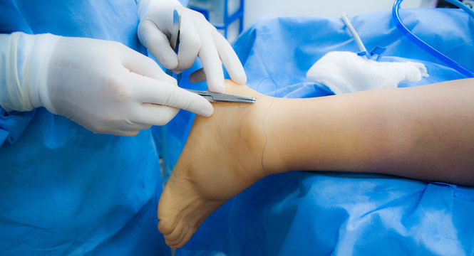 ankle surgery
