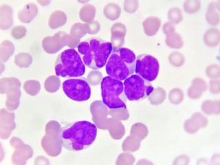 Blood picture of acute myeloid leukemia (AML), analyze by microscope
