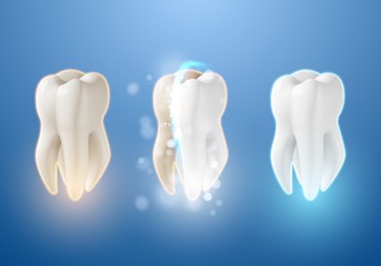 Illustration of Teeth Whitening System. 3D Realistic Vector Tooth Cleaning Process Illustration