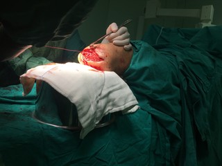 Amputation surgery