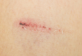 scraped skin