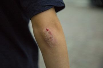 wound on the elbow