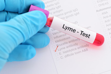 Blood sample for Lyme disease test