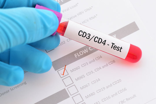 Blood sample for CD3/CD4 test