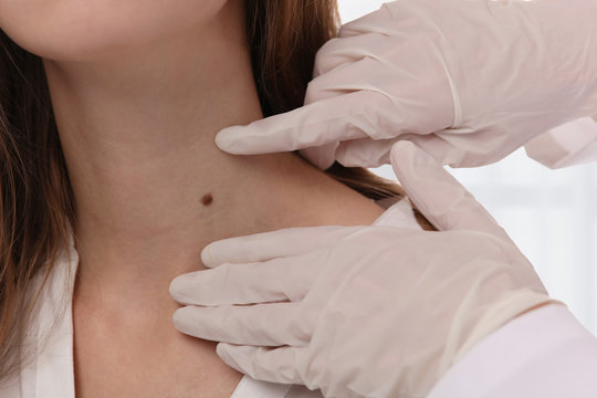 Doctor dermatologist examines birthmark of patient close up. Checking benign moles. Laser Skin tags removal