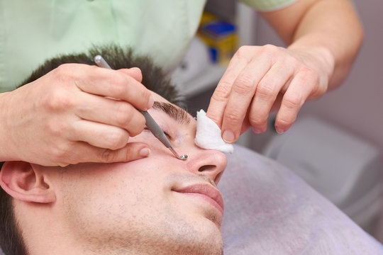 Young man having face cleaned. Hands with blackhead remover.