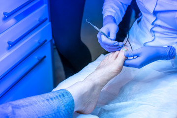 Treatment of nails. Ingrown nail. pedecure.