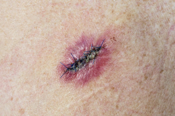 Post operative stitched incision from the removal of a Basal Cell Carcinoma looking sore and infected 