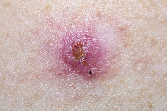 Basal Cell Carcinoma On A Mature Female 