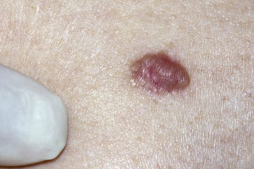Basal Cell Carcinoma being examined by a dermatologist