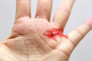 Close up of a bleeding cut hand with tiny shards of glass.