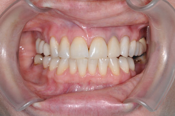Close up of a patient's mouth at a dental clinic