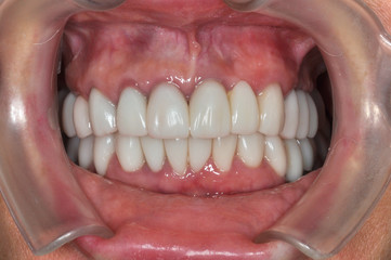 Obraz premium Close up of a patient's mouth at a dental clinic