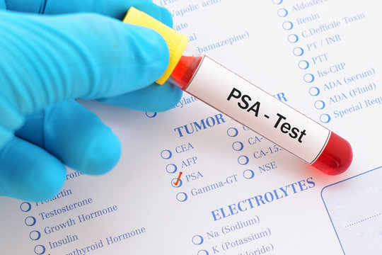 Blood sample with requisition form for PSA test
