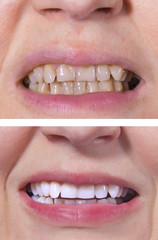 Teeth whitening - BEFORE and AFTER