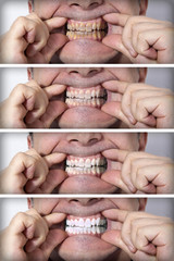 Stages of teeth whitening - BEFORE and AFTER