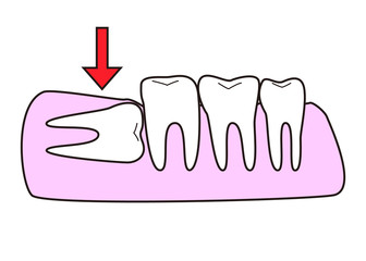 横向き親知らず