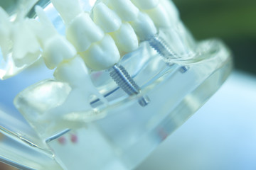 Dentsts dental tooth implant