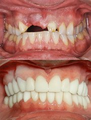 Close up of a patient's mouth at a dental clinic. Before and after