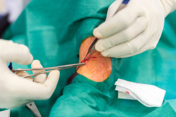 point de suture