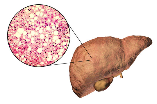 Fatty liver, liver steatosis, 3D illustration and photomicrograph showing large vacuoles of triglyceride fat accumulated inside liver cells, it occurs in alcohol overuse, under action of toxins