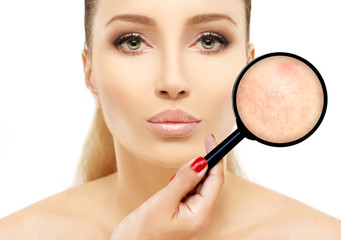 Post-Acne Marks /Treating Acne Scars