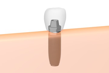 Dental implant/ tooth implant