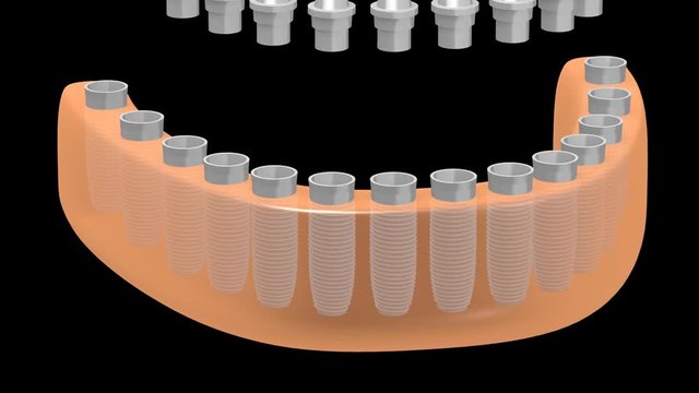 3D dental implants/ teeth implants animation - on black background.